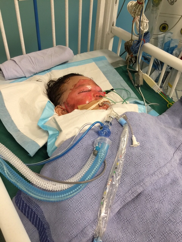 
Cậu bé Aafaa bị bỏng nặng do chảo dầu nóng đổ lên người.
