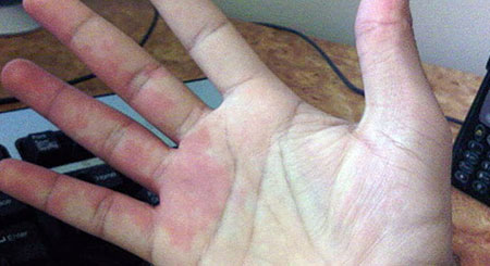 Màu sắc lòng bàn tay của người khỏe mạnh thường là màu hồng hoặc đỏ nhạt, có thấy được các tia máu.