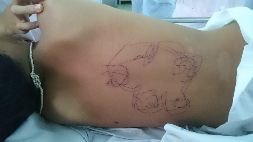 
Bé trai được vẽ bùa vào lưng để trị bệnh. Ảnh: H.K
