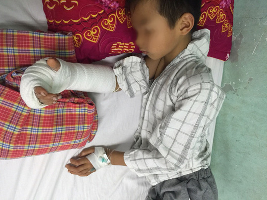 B&agrave;n tay của bệnh nhi hồi phục tốt sau ca phẫu thuật nối tay