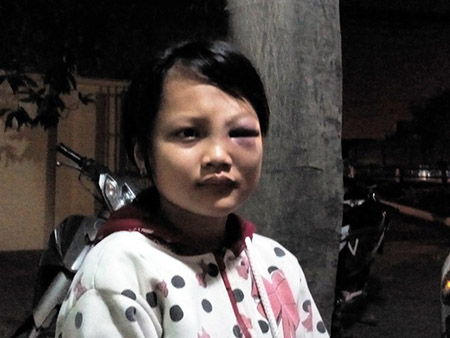 Nguyễn Thị Hồng Đào bị đánh bầm dập vùng mặt. Ảnh: N.A
