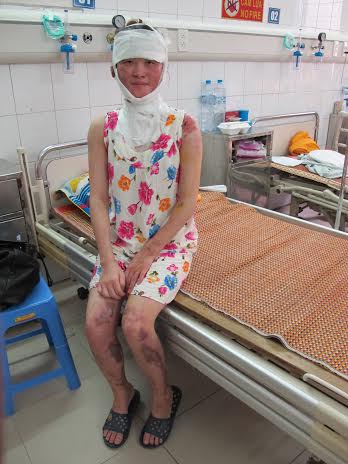 
Bệnh nhân Linh sau 2 tháng điều trị tại Khoa Bỏng-BVĐK Xanh pôn.
