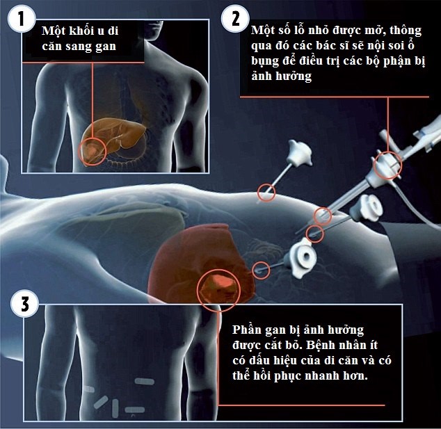Kỹ thuật nội soi giúp cắt bỏ gan do ung thư đại tràng di căn. Ảnh: Dailymail.