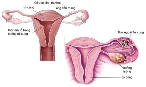 
Hình ảnh một túi thai ngoài tử cung. Ảnh minh họa.
