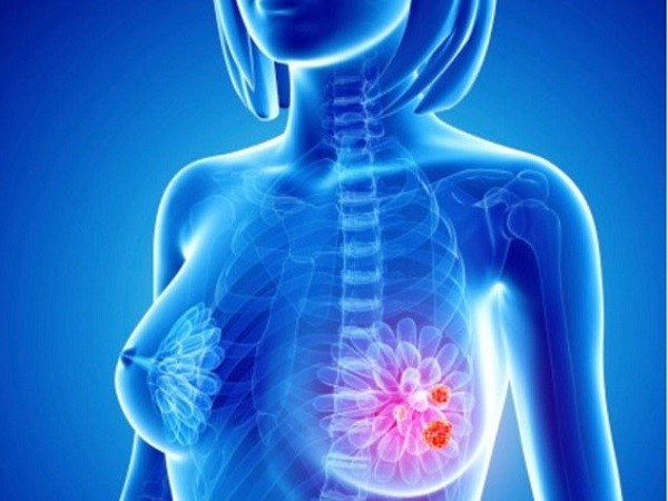40 loại gen đột biến được phát hiện là nguyên nhân gây ung thư vú.