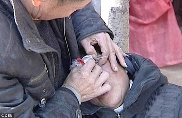 &Ocirc;ng Liang gắp vi&ecirc;n sỏi ra khỏi mắt vợ. Ảnh:&nbsp;CEN