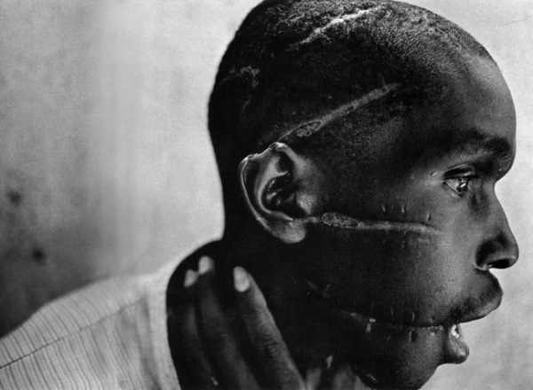 
10. Dẫu đã thoát chết nhưng những vết sẹo này vẫn sẽ luôn ám ảnh cậu bé gốc Rwanda tới suốt phần đời còn lại.
