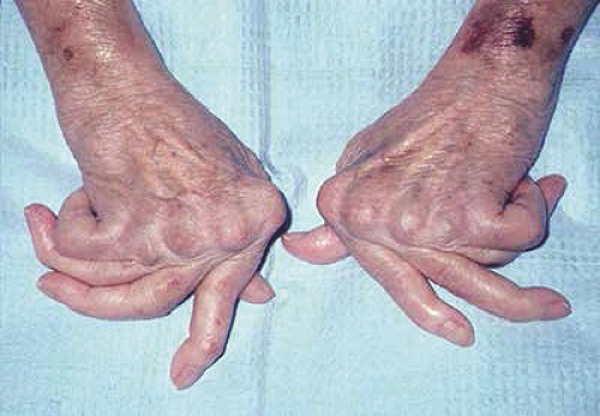 
Đôi tay bệnh nhân biến chứng do viêm khớp dạng thấp
