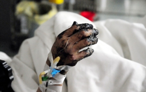 
Nhiều người bị nhựa đường dính khiến toàn bộ bàn tay bị bỏng nặng.

