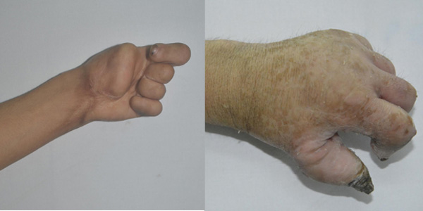 Ca mổ tách tay cho bệnh nhân Hoàng Văn Thống