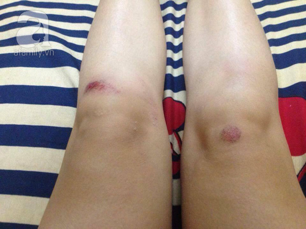Hậu quả l&agrave;m anh T&ugrave;ng bi thương ở hai ch&acirc;n
