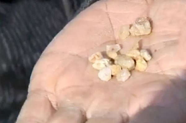 Những vi&ecirc;n sỏi được lấy ra khỏi mắt Liang. Ảnh:&nbsp;CEN