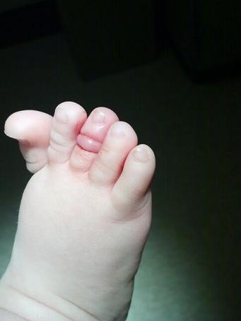 Nếu trẻ không may bị sợi tóc thắt vào ngón chân, mẹ cần tỉnh táo và kịp thời xử lý.
