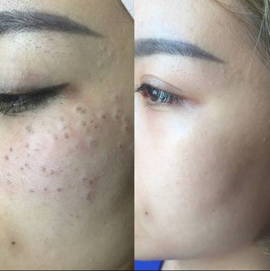 
Trước và sau khi trị nám bằng công nghệ laser
