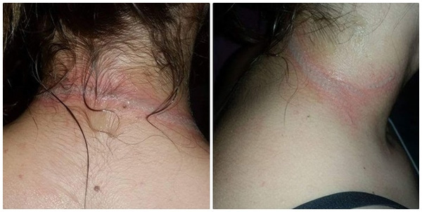 Vết thương trên cổ cô bé Gabbie. (Ảnh: Internet)