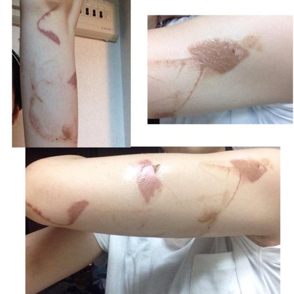 Một cô gái người Nhật cũng đã gặp phải tình trạng này và đã chia sẻ ảnh những vết sẹo trên cánh tay do loại hóa chất trong loại ốp lưng bắt mắt gây ra. (Ảnh: Twitter)
