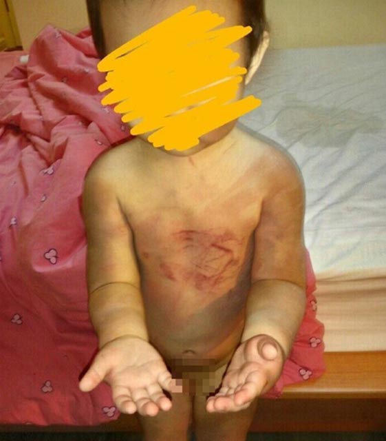 Hình ảnh tay, chân, vai, lưng của bé đều bị thương, khắp cơ thể đều rướm máu và thâm tím.