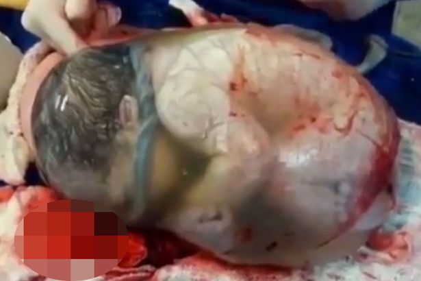 
Ca sinh nở hi hữu này diễn ra tại một bệnh viện ở Tây Ban Nha. Hình ảnh từ video clip cho thấy em bé nằm cuộn tròn trong túi nước ối giống như một quả bóng, mọi cử động của bé đều được nhìn thấy.

