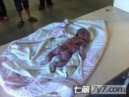 
Hình ảnh lưng em bé bị cháy đen khiến mọi người không khỏi xót xa
