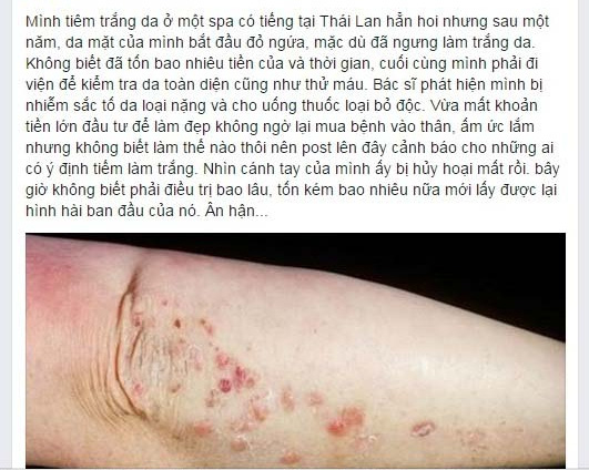 Status trên Facebook của Hienanh2 cảnh báo về việc tiêm làm trắng.