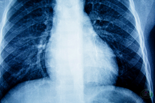 Kim nhọn dài 2,5 cm nằm trong phổi bé K.