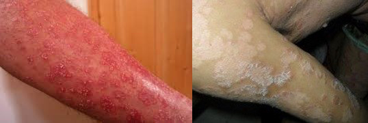 Đông y Bảo Thanh Đường chữa dứt điểm các bệnh ngoài da như bệnh vẩy nến, bệnh chàm, viêm nang lông và các bệnh nội tiết bằng thuốc thảo dược theo bí quyết gia truyền.