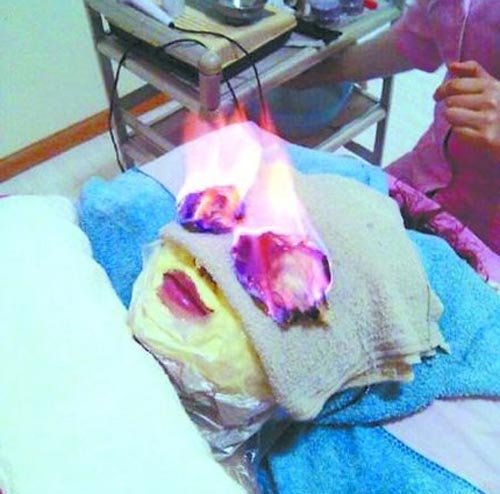 
Phương pháp làm đẹp bằng cách đốt mắt (Ảnh minh họa)
