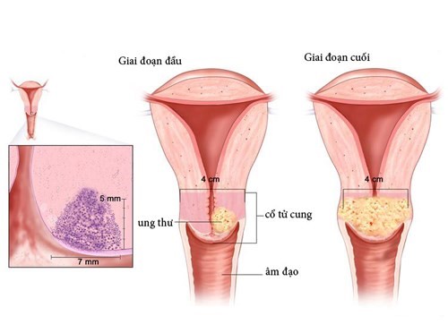 
Ung thư cổ tử cung đứng thứ 3 sau các bệnh ung thư khác.
