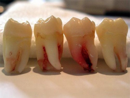 
“Răng khôn” trở thành nguy hiểm vì viêm răng khôn có thể gây tử vong do nhiễm trùng máu.
