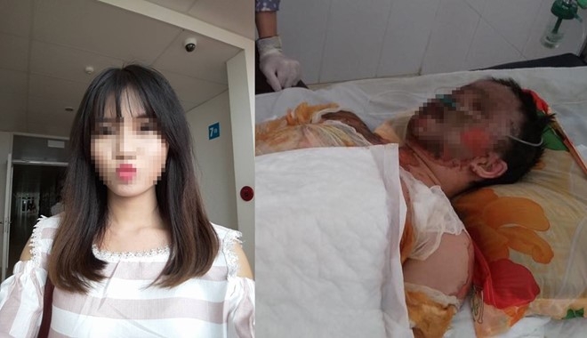 Từ một c&ocirc; g&aacute;i xinh đẹp, Hằng bị bỏng to&agrave;n th&acirc;n, khu&ocirc;n mặt biến dạng v&agrave; hai tay ch&aacute;y kh&ocirc;.