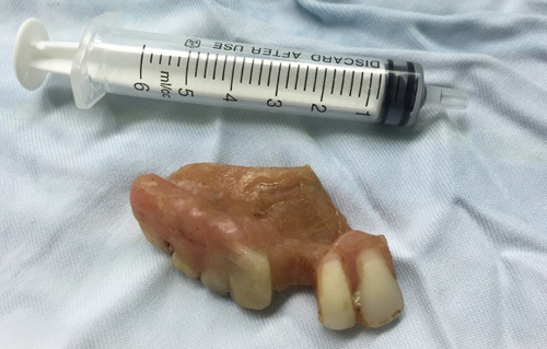 
Hàm răng giả được lấy ra từ thực quản nam bệnh nhân. Ảnh: Bác sĩ cung cấp.

