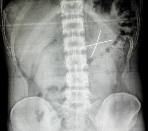 Kết quả X-quang bụng cho thấy dị vật có dạng chữ X.