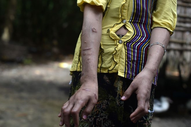 
Bàn tay đã bị biến dạng sau nhiều lần bị bẻ của Khine. Ảnh: AFP
