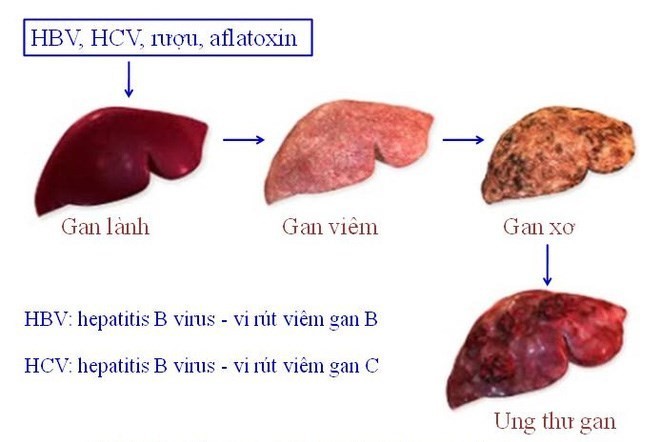 Tiến trình ung thư gan.