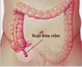 Khi trẻ có dấu hiệu viêm ruột thừa, cần đưa trẻ đến bệnh viện càng sớm càng tốt.