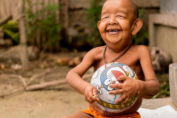 Căn bệnh quái ác còn khiến mọi sinh hoạt của em gặp khó khăn.