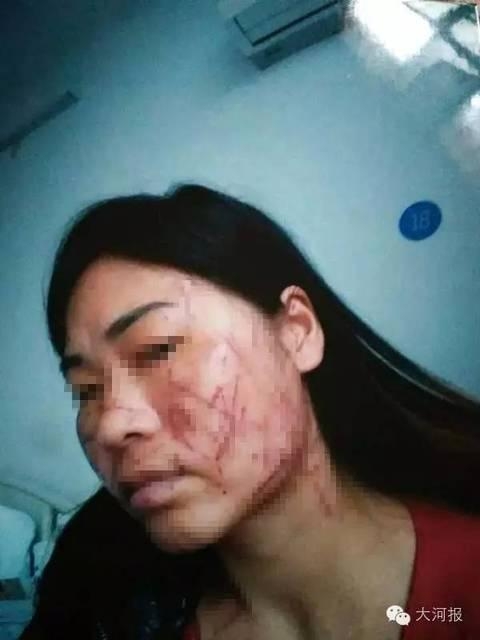 Khu&ocirc;n mặt chằng chịt vết sẹo trở th&agrave;nh nỗi đau rất lớn của Cảnh Hải Anh.