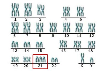 Có đến 3 NST số 21 - ở người mắc hội chứng Down