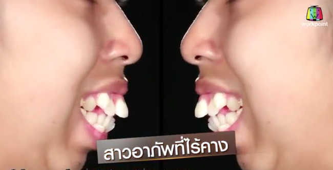 
Jitraporn có phần răng, miệng không mấy đẹp mắt.
