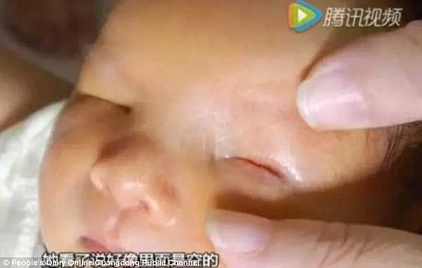 
Điều đáng nói cho đến thời điểm hiện tại vẫn chưa có phương pháp điều trị để phục hồi đôi mắt cho trẻ mắc bệnh anophthalmia.
