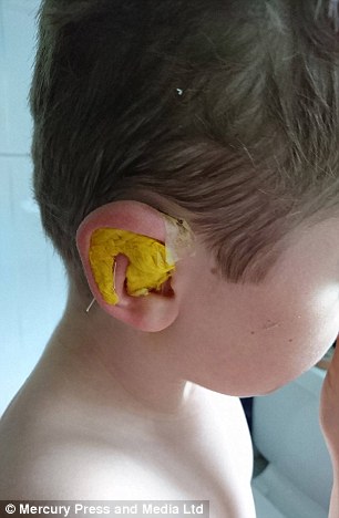 
Cậu bé đã dũng cảm thực hiện ca phẫu thuật thu hẹp tai. (Ảnh: Mercury Press and Media Ltd).
