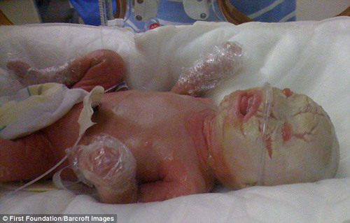 
Khi Evan ra đời, da của bé quá dày đến nỗi không thể mở mắt trong tuần đầu tiên
