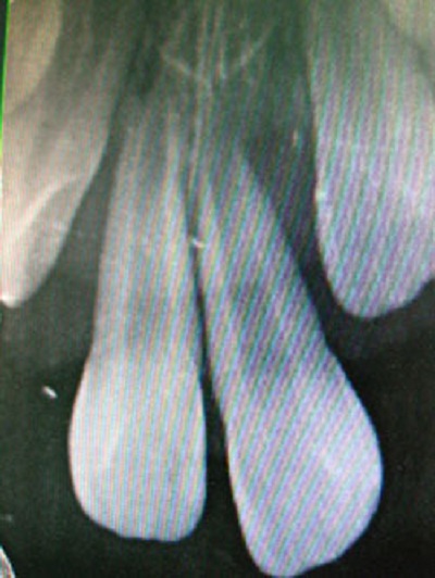 Phim X quang trước điều trị cho thấy hai răng của bé gái bị trồi ra khỏi xương ổ răng, nếu để thêm một thời gian nữa thì bé sẽ bị rụng mất răng. Ảnh: M.S