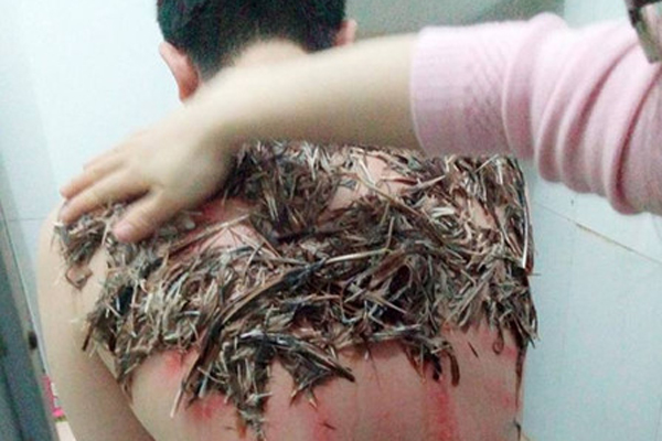 
Hình ảnh trị bệnh đậu Lào bằng lông   tiết   nước chần gà đang gây xôn xao

 

 
