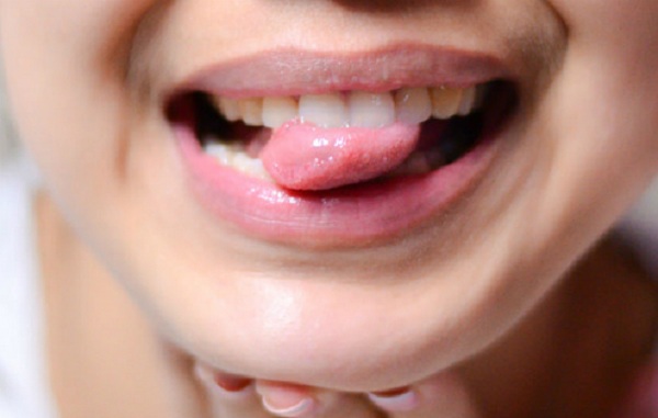 
Ung thư lưỡi dễ bị bỏ qua vì nhầm với nhiệt miệng. Ảnh minh họa
