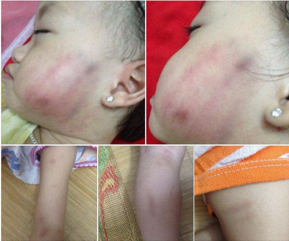 
Nhiều vết thâm tím trên mặt và tay chân bé gái 17 tháng tuổi. Ảnh: Gia đình cung cấp
