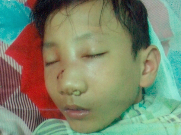 
Ch&aacute;u Hạnh khi đang điều trị &ldquo;sai khớp sụn v&aacute;ch mũi&rdquo; ở bệnh viện (ảnh do gia đ&igrave;nh nạn nh&acirc;n cung cấp).
