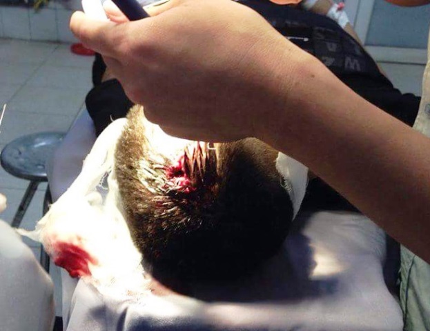 
Vết thương trên đầu của Vũ Huy Phương sau khi bị CSGT bắn đạn cao su. Ảnh: B.Đ
