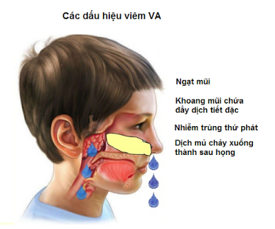 
Các dấu hiệu chính khi trẻ mắc viêm VA. Ảnh: BVCC
