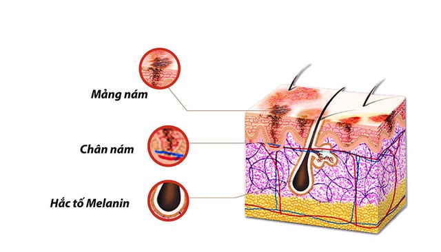 
Gốc nám nằm sâu dưới da
